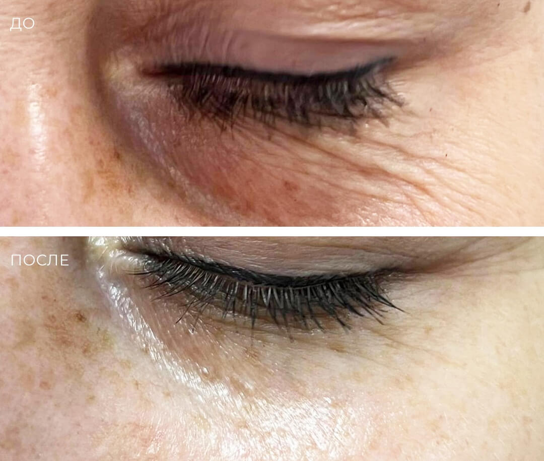 Биоревитализация